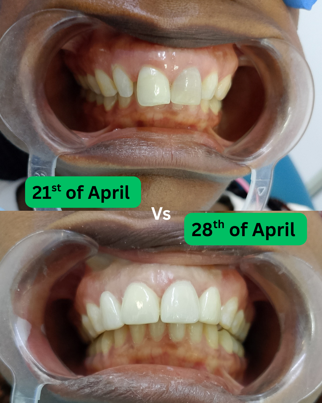 Crowns result 2